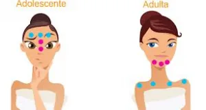 nutricionista tratamento acne