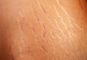 Dicas nutricionais para a prevenção de estrias