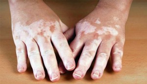 Vitiligo X Nutrição Saudável