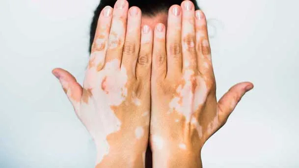 Orientações nutricionais no Vitiligo