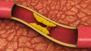 Hipercolesterolemia