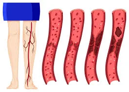 Uso de anticoagulantes