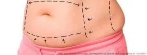 Alimentação Adequada Pós-Abdominoplastia