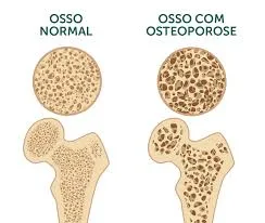 Dicas nutricionais na osteoporose