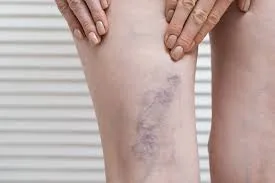 Orientação nutricional nas varizes